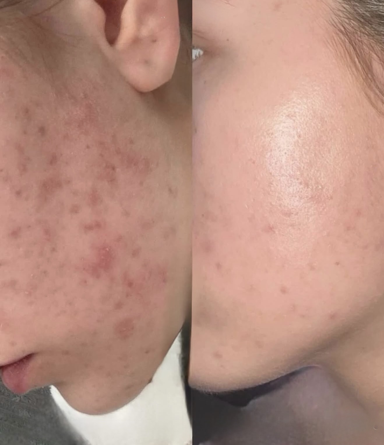 Before and after acne and inflammation improvement