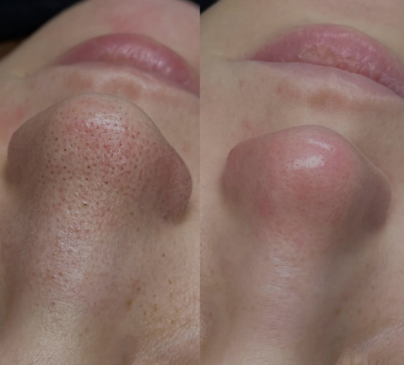 Before and after enlarged pores on the nose