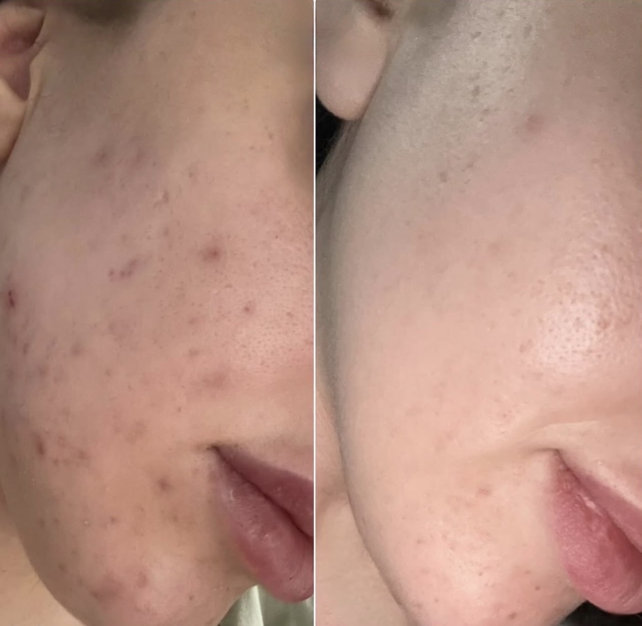 Before and after breakouts and post-acne marks